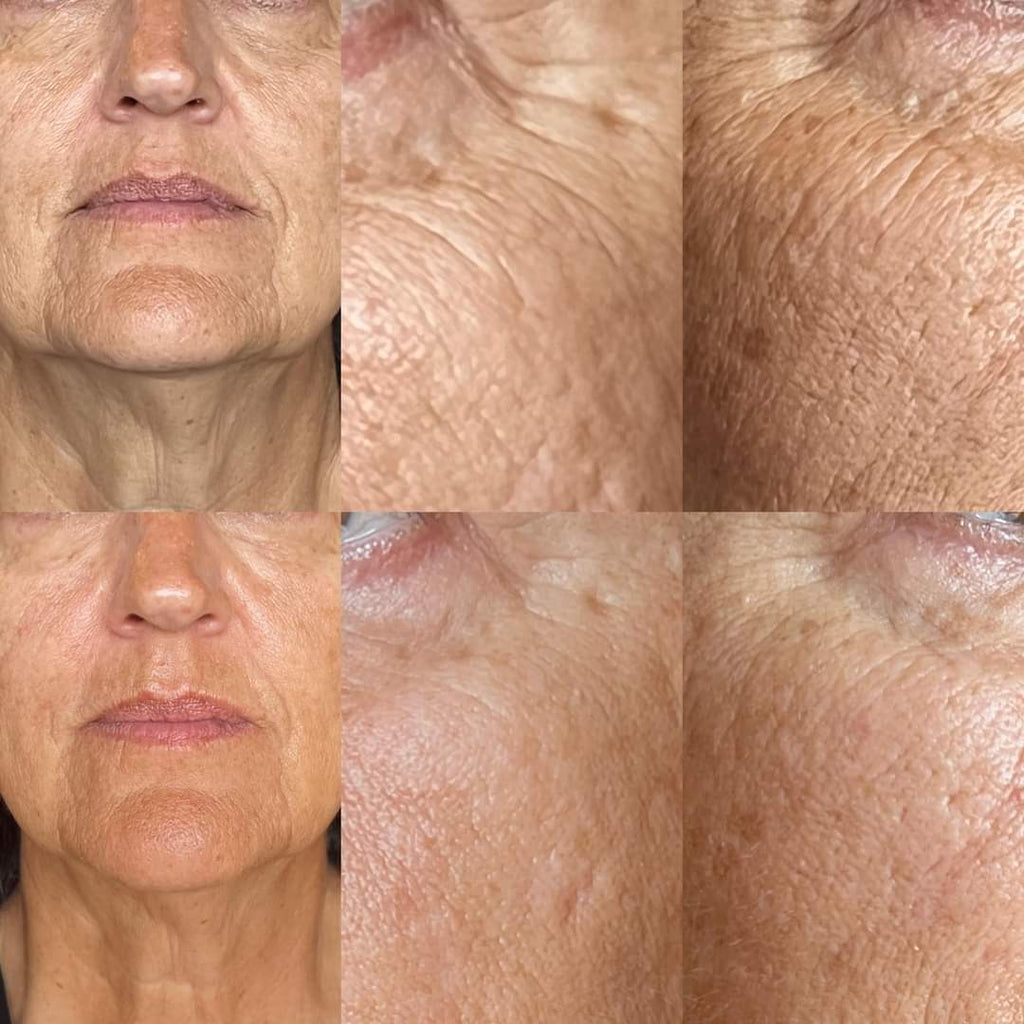 Plasma Skin Tightening